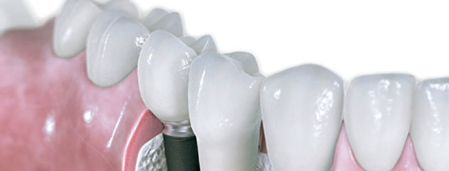 Dental Implant Treatment