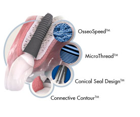 Dental Implant